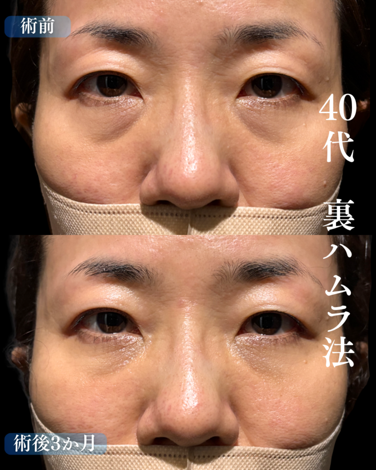 40代女性　裏ハムラ法